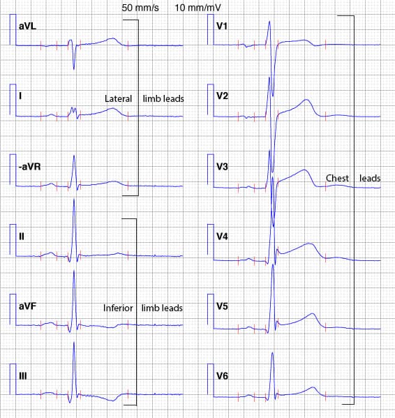 Illustration ur kursen The Normal ECG: From Normality to Pathology
