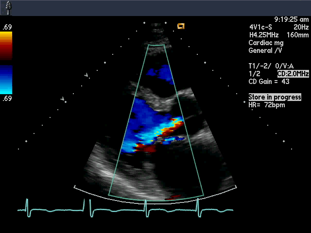 Illustration ur kursen Akuter Myokardinfarkt: Pathophysiologie, Kriterien und klinische Phänotypen