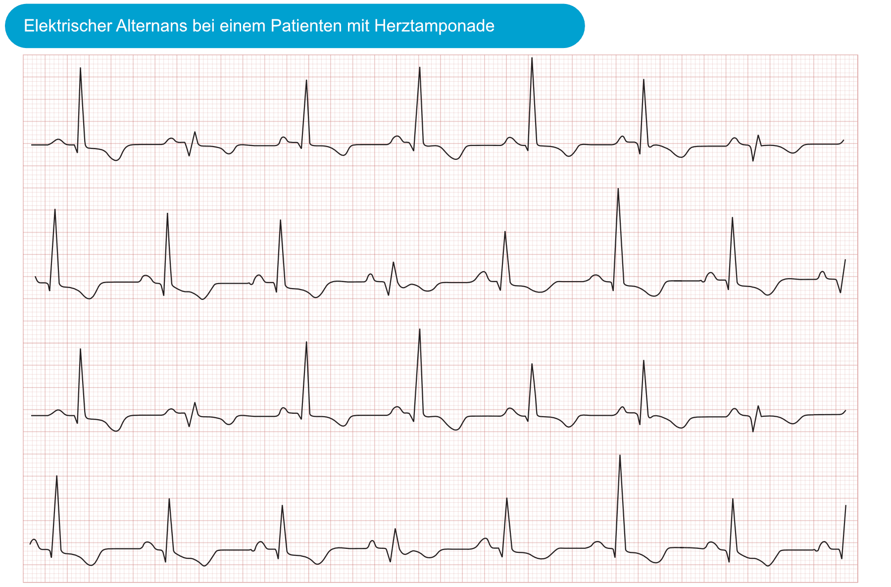 Illustration ur kursen EKG-Test 2