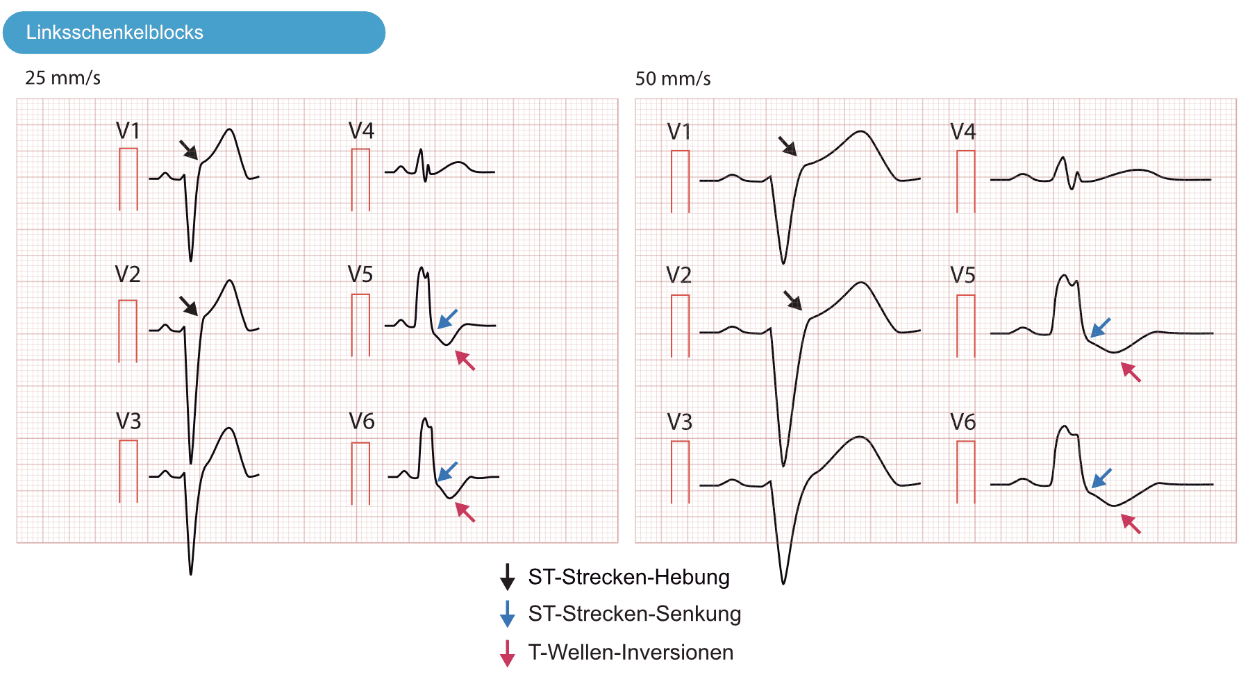 Illustration ur kursen Ventrikuläre Arrhythmien und plötzlicher Herztod - 1