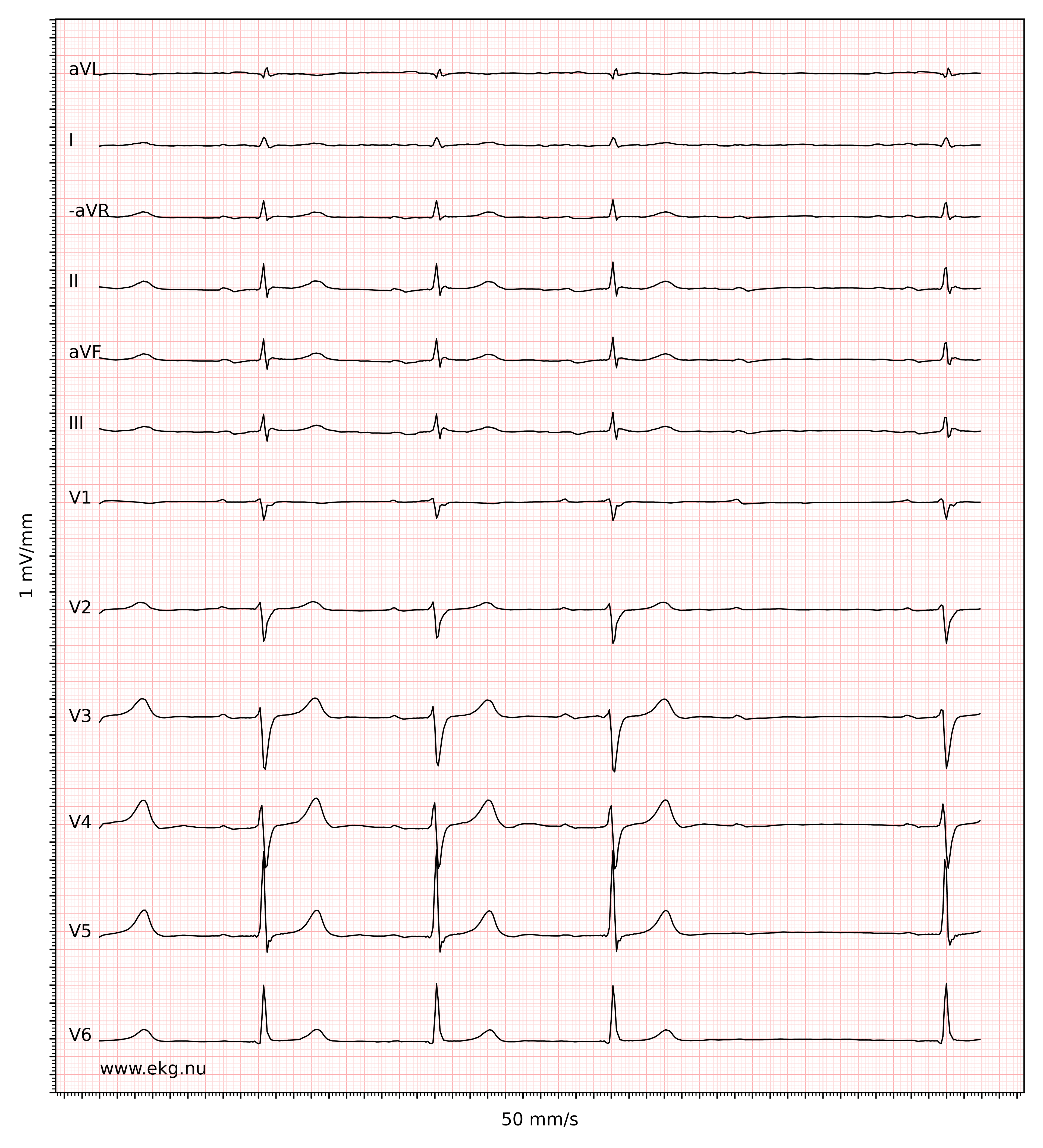 Illustration ur kursen Supraventrikuläre Arrhythmien