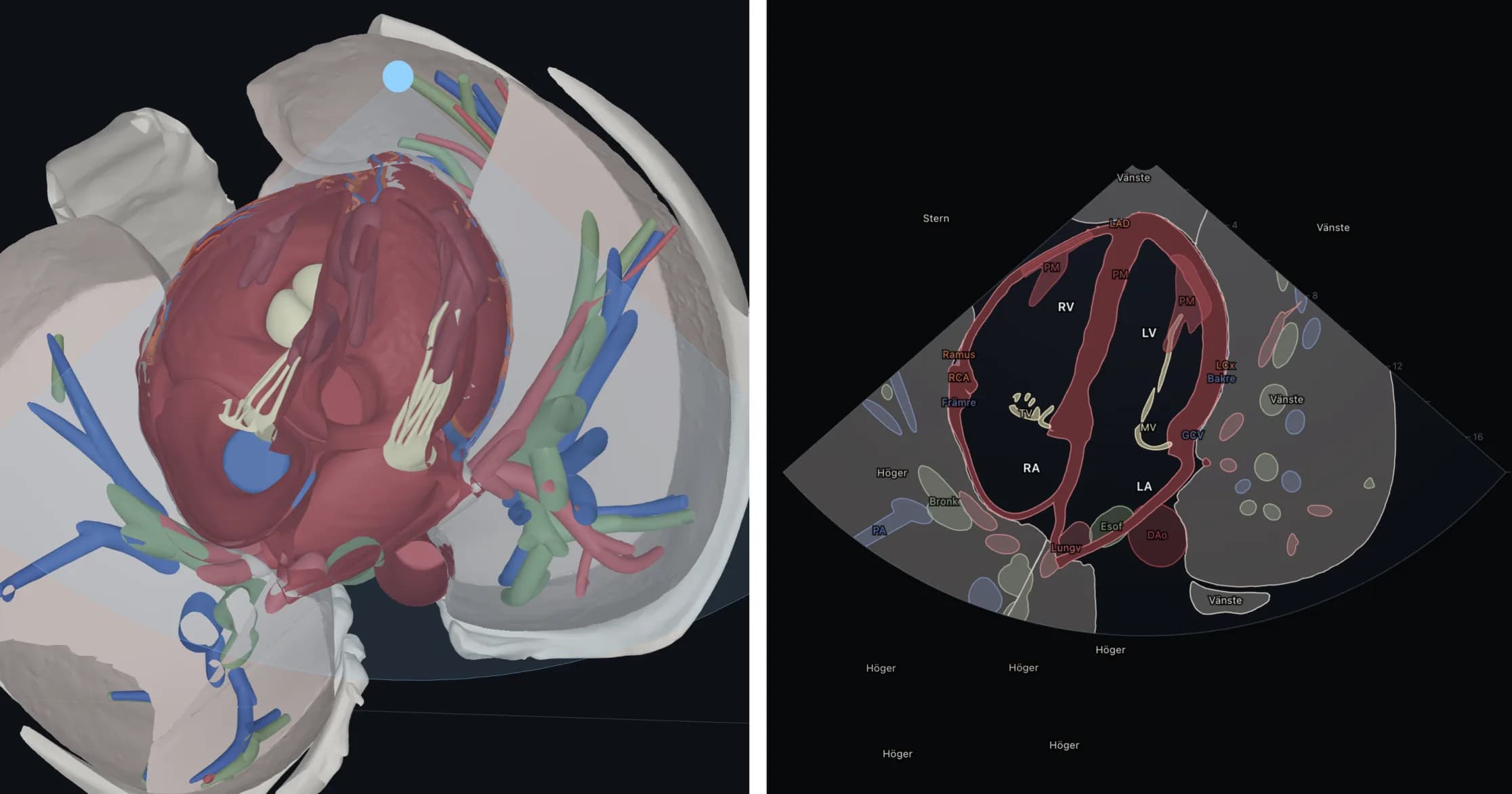 Das Herz in 3D im apikalen Vierkammerblick geschnitten, daneben derselbe Schnitt als Ultraschallbild