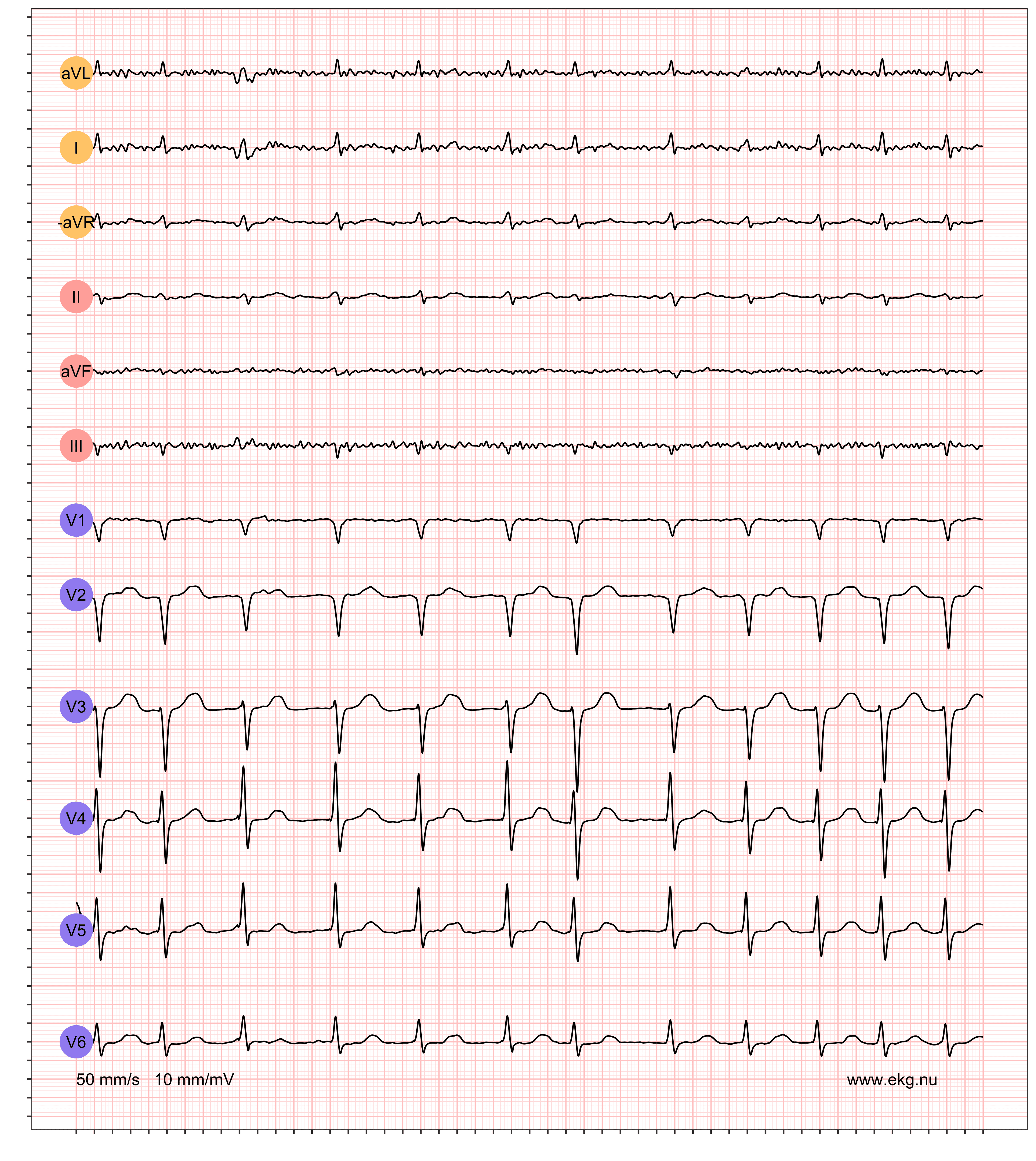 12 AFIB NONE VR 146 AR 163 QRSdur 82 QTdur 322