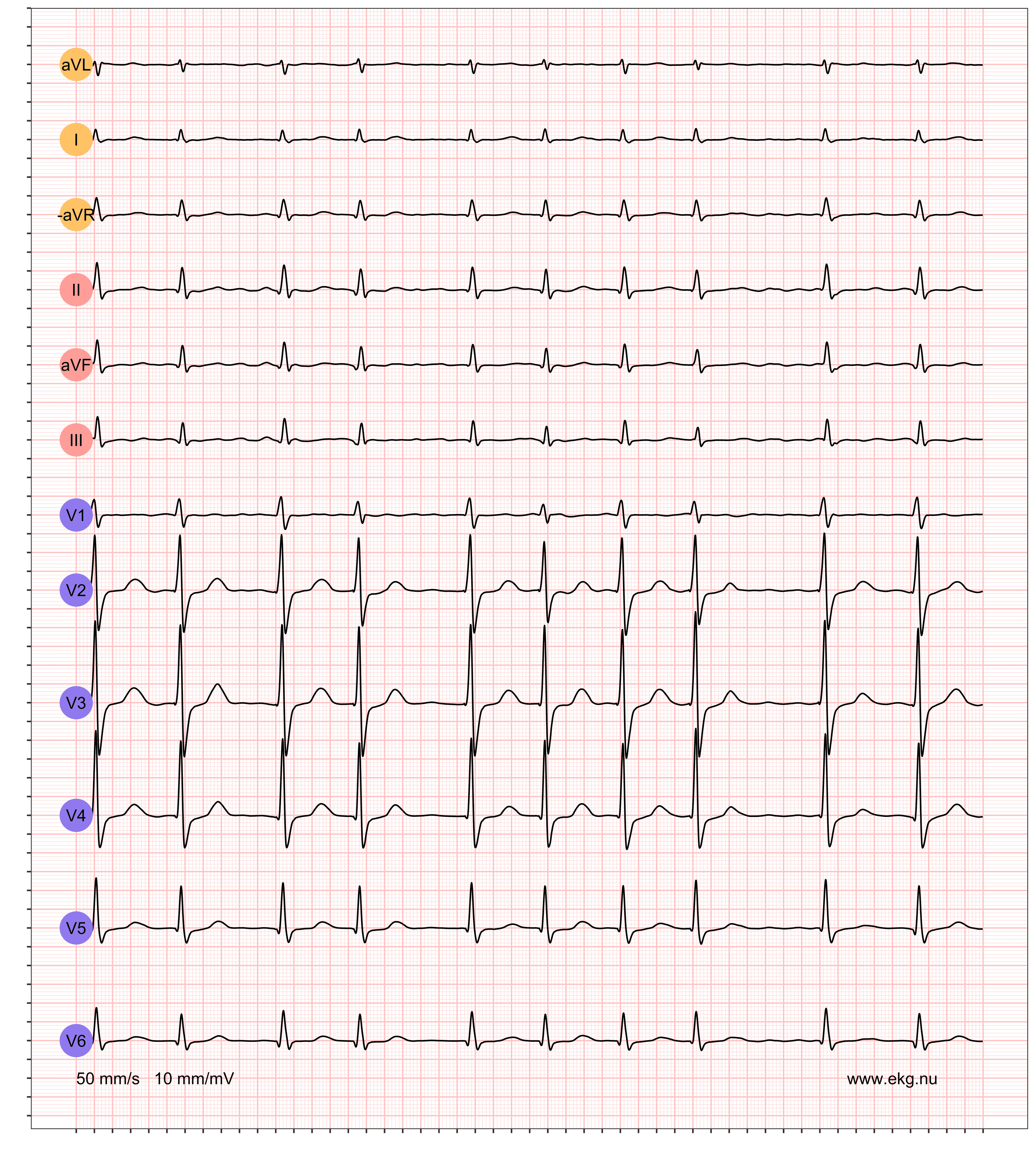 132 AFIB NONE VR 119 AR 127 QRSdur 98 QTdur 348