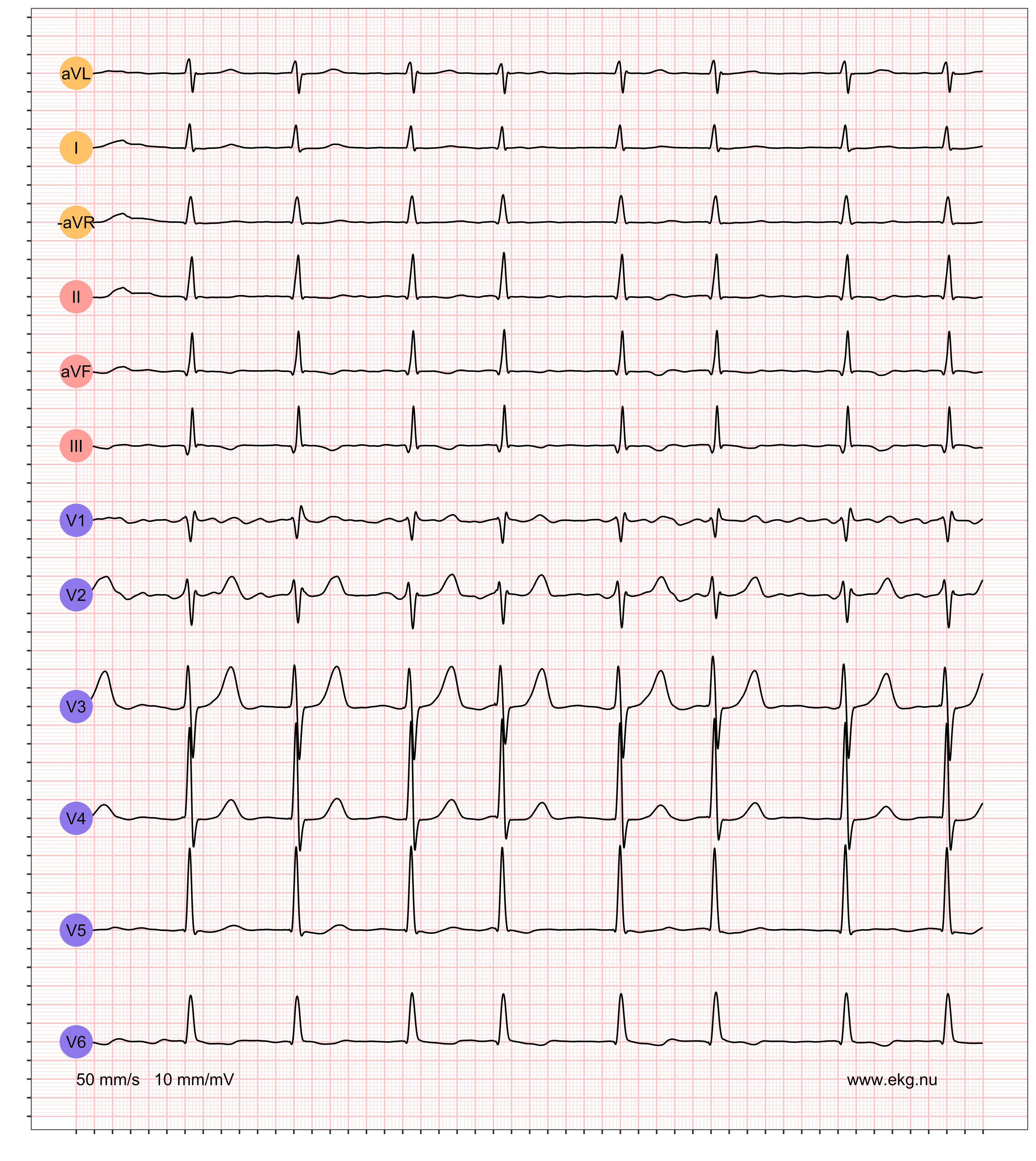 14 AFIB RBBB STDD STTC VR 91 AR 84 QRSdur 104 QTdur 354