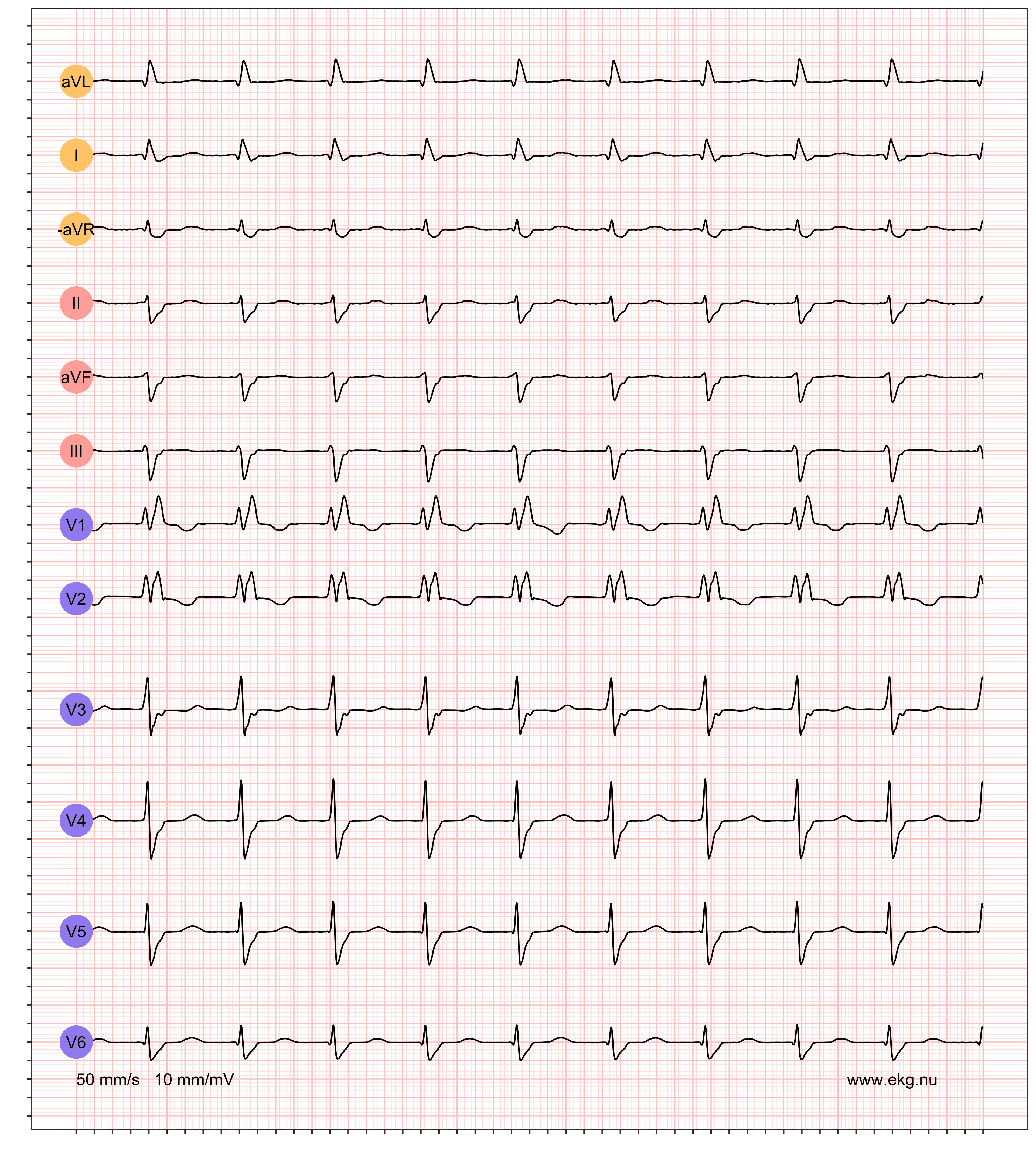 345 AF AVB LFBBB RBBB VR 117 AR 234 QRSdur 126 QTdur 370