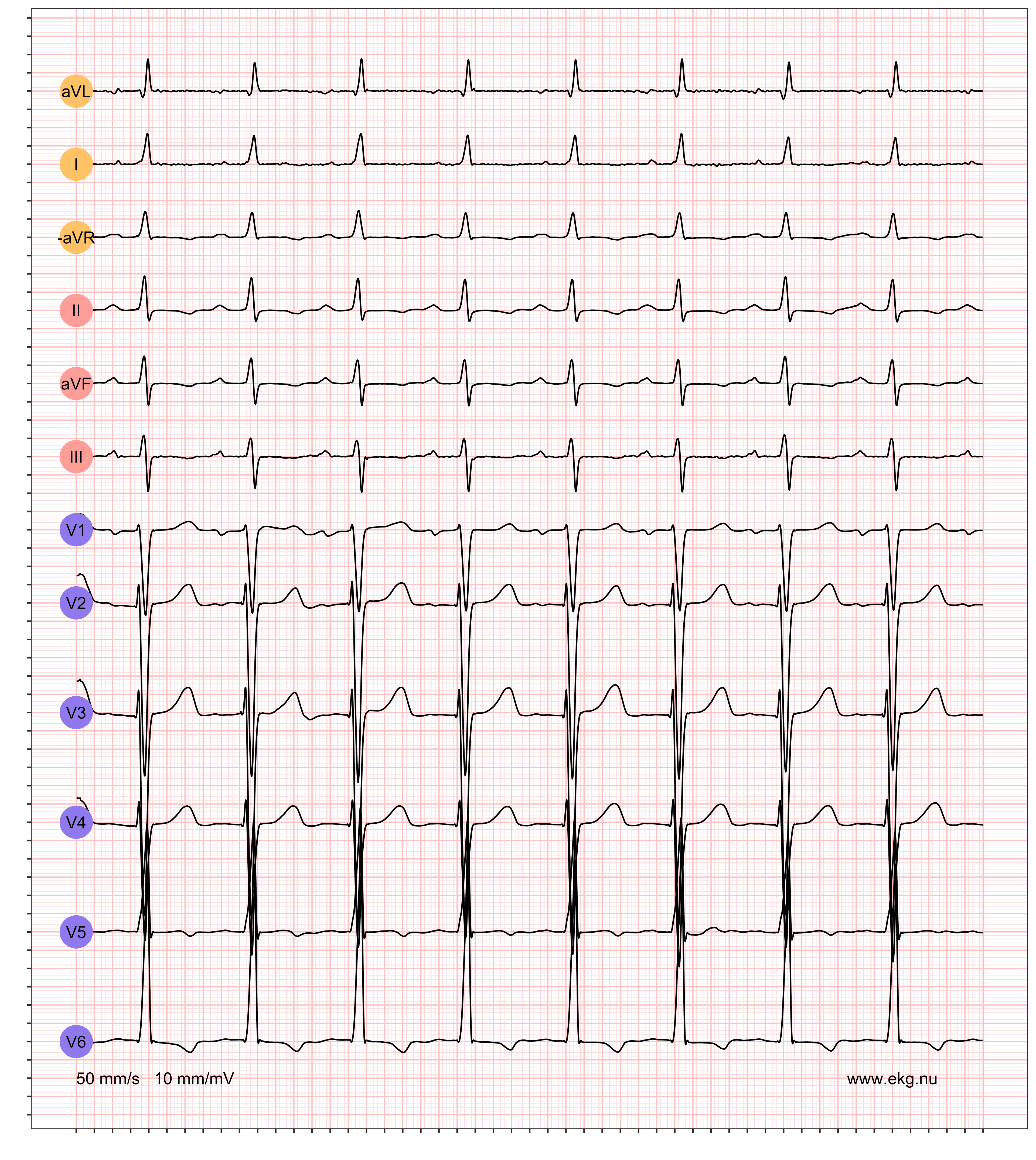 5 ST LVHV PWC STTC VR 102 AR 102 QRSdur 92 QTdur 370