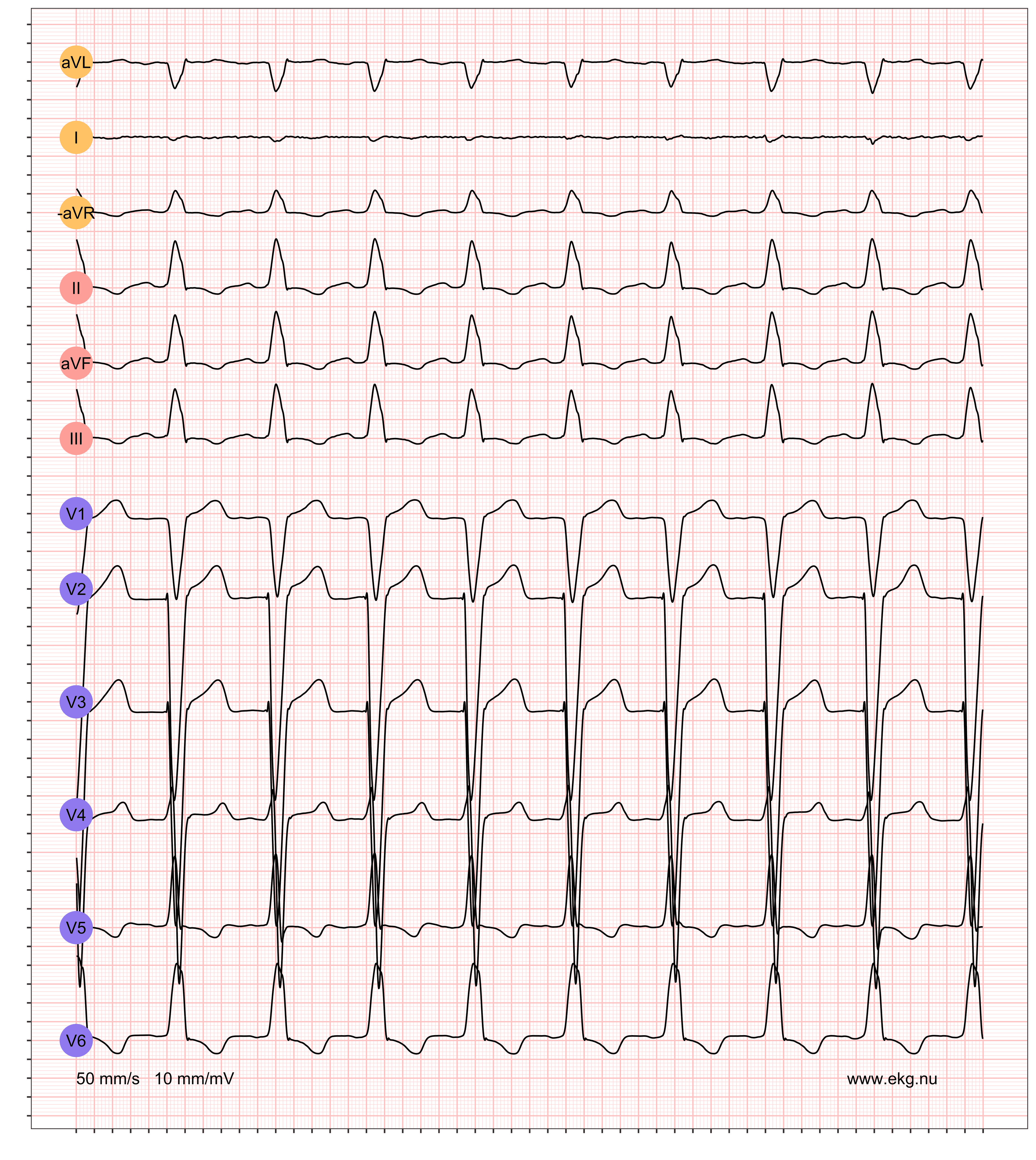 526 ST ARS LBBB VR 110 AR 110 QRSdur 126 QTdur 388