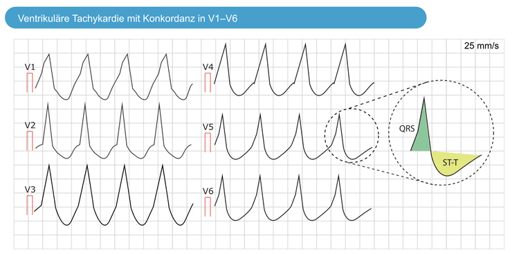 Abbildung 7. Konkordanz in QRS-Komplexen von V1 bis V6 bei ventrikulärer Tachykardie.