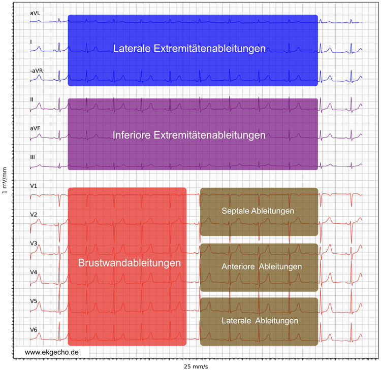 Abbildung 21. Präsentation des EKG-Ableitungen im Cabrera-Format, aVR wurde invertiert zu –aVR.