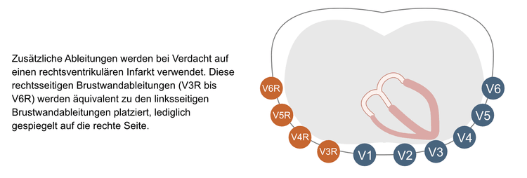 Abbildung 22. Die rechtsseitigen Brustwandableitungen bei rechtsventrikulärem Infarkt. Diese Ableitungen sollten ergänzt werden, falls der Verdacht auf einen rechtsventrikulären Infarkt besteht.