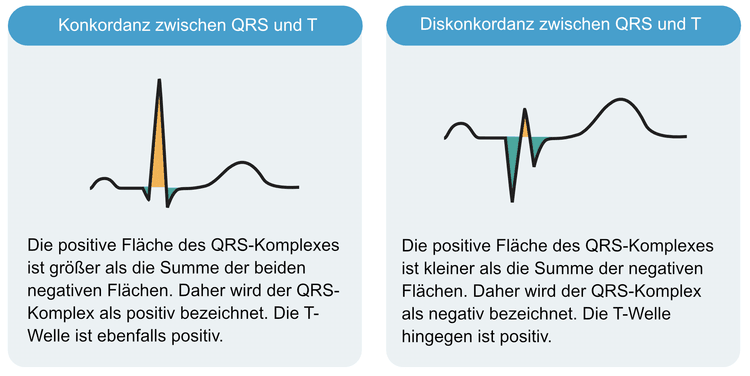 Abbildung 8. Konkordante und diskordante T-Wellen.