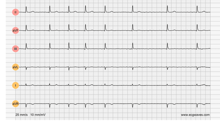 EKG-Testbibliothek: Frage 3