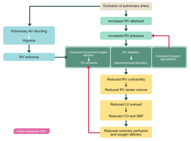 Pathophysiology of pulmonary embolism (PE).