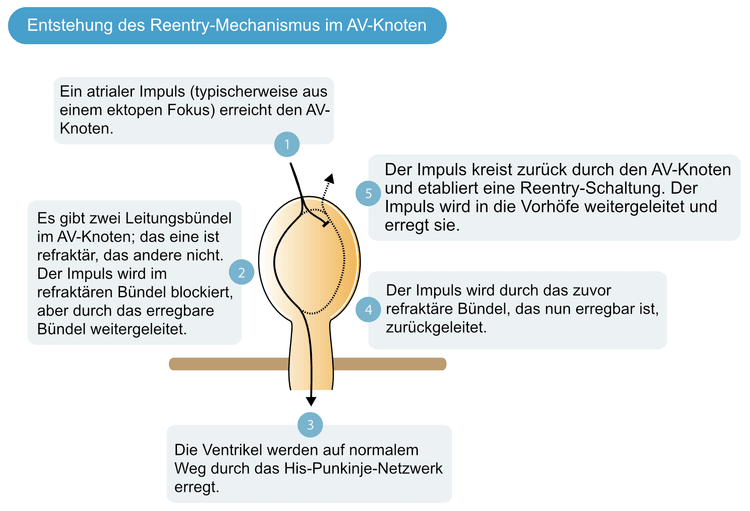 Abbildung 1. Mechanismus, der zu einer AV-Knoten-Reentrytachykardie führt.