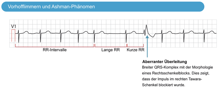 Abbildung 4. Das EKG zeigt ein Ashman-Phänomen bei Vorhofflimmern.