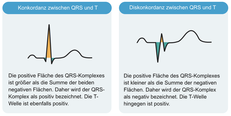 Abbildung 17. Diskordanz und Konkordanz zwischen QRS und ST-T.