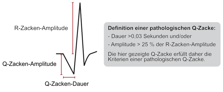 Abbildung 11. Kriterien für pathologische Q-Zacken.