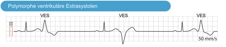 Abbildung 4. Polymorphe ventrikuläre Extrasystolen. Polymorphe ventrikuläre Extrasystolen zeichnen sich durch eine variierende QRS-Morphologie aus, weisen aber ein konstantes zeitliches Auftreten auf. Diese ektopen Schläge stammen aus demselben ektopen Fokus, aber die Impulse werden von Schlag zu Schlag unterschiedlich weitergeleitet.