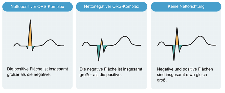 Abbildung 6. Die Nettorichtung des QRS-Komplexes. Die positiven Flächen sind gelb und die negativen Flächen sind grün.