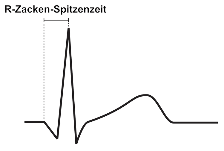Abbildung 9. Die R-Zacken-Spitzenzeit ist definiert als das Zeitintervall zwischen dem Beginn des QRS-Komplexes und der Spitze der R-Zacke.