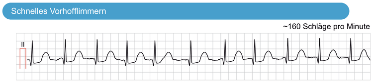 Abbildung 3. Schnelles Vorhofflimmern. Der Rhythmus kann nahezu regelmäßig erscheinen, wenn die Herzfrequenz sehr schnell ist. Dieses EKG zeigt Vorhofflimmern mit 160 Schlägen pro Minute. Auf den ersten Blick mag der Rhythmus regelmäßig erscheinen, aber eine genauere Analyse zeigt, dass es keine P-Wellen gibt und die RR-Intervalle leicht unregelmäßig sind (dies führt zur Diagnose Vorhofflimmern). Zu beachten ist, dass das EKG außerdem leichte ST-Strecken-Senkungen zeigt, was ein häufiger Befund bei Tachyarrythmien ist.