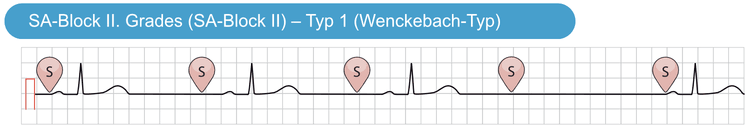 Abbildung 2. Sinuatrialer Block II. Grades, Typ 1 (Wenckebach-Typ).
