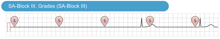Abbildung 4. SA-Block III. Grades. Es werden keine Sinusimpulse zu den Vorhöfen weitergeleitet. Bevor der vierte Sinusimpuls erzeugt wird, manifestiert sich ein junktionaler Ersatzrhythmus. Dies ist an der normalen Dauer des QRS-Komplexes (was den supraventrikulären Ursprung anzeigt) und an der fehlenden P-Welle vor dem QRS-Komplex erkennbar.