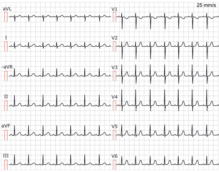 Abbildung 1. Das EKG zeigt eine Sinustachykardie. Papiergeschwindigkeit 25 mm/s. Berechnen Sie die Herzfrequenz, indem Sie 300 durch die Anzahl der großen Kästchen zwischen R-Zacken teilen. Es liegen ungefähr 3 große Kästchen zwischen den R-Zacken; 300/3 entspricht 100 Schlägen pro Minute.
