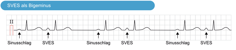 Abbildung 6. Supraventrikuläre Extrasystolen (SVES) als Bigeminus.