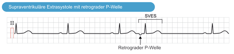 Abbildung 2. Supraventrikuläre Extrasystole mit retrograder P-Welle. Der vierte Schlag ist eine supraventrikuläre Extrasystole. Die P-Welle ist invertiert (retrograd) und zeigt dadurch an, dass der ektope Fokus von den Vorhöfen entfernt liegt (vermutlich um den AV-Knoten herum). Die Erregung der Vorhöfe verläuft in umgekehrter Richtung.