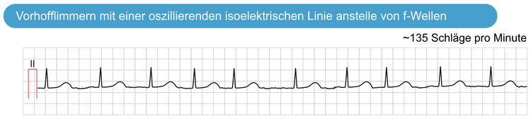 Abbildung 2. Vorhofflimmern mit einer oszillierenden isoelektrischen Linie anstelle von f-Wellen. f-Wellen sind nicht sichtbar, stattdessen erscheint die isoelektrische Linie oszillierend.