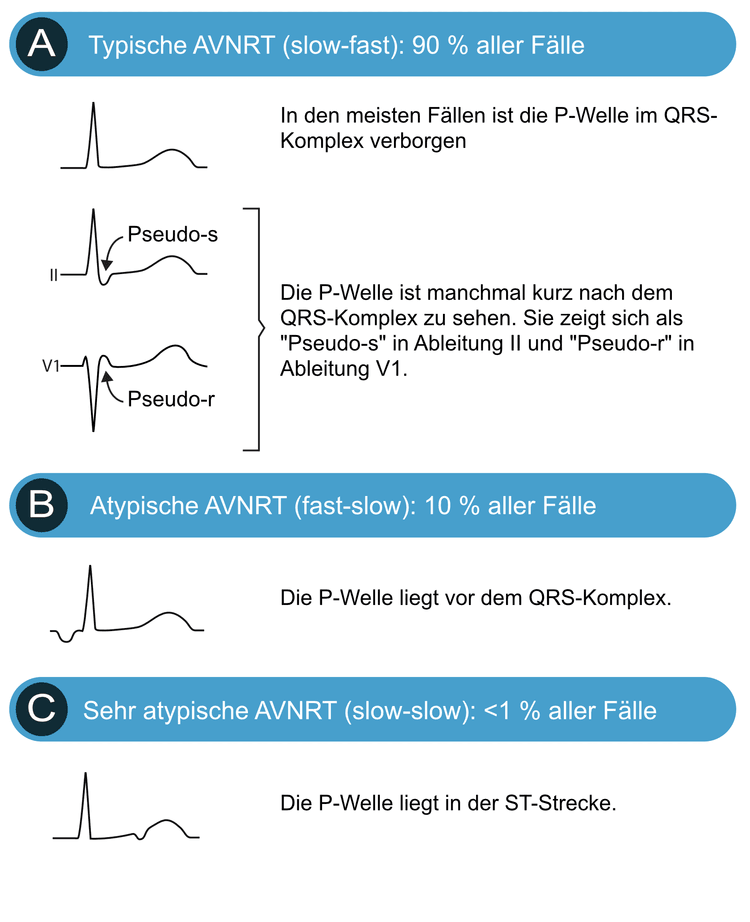 Abbildung 2. Arten der AV-Knoten-Reentrytachykardie.