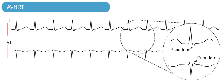 Abbildung 3. AV-Knoten-Reentrytachykardie bei einem 20-jährigen Mann, der unter Herzrasen leidet. Ableitung II: Die retrograde P-Welle direkt nach dem QRS-Komplex imitiert eine S-Zacke, weshalb sie als Pseudo-s bezeichnet wird. Ableitung V1: Die P-Welle ist auch kurz nach dem QRS-Komplex in V1 zu sehen, wo sie eine R-Zacke imitiert, weshalb sie als Pseudo-r bezeichnet wird.