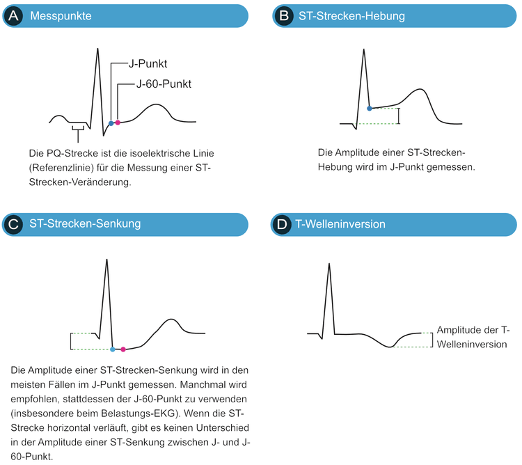 Abbildung 2. Diese Abbildung veranschaulicht ST-Hebung, ST-Senkung und T-Welleninversion. Patienten mit STEMI (STE-ACS) zeigen immer ST-Hebungen, können aber auch ST-Senkungen und/oder T-Welleninversionen aufweisen. Patienten mit NSTE-ACS (NSTEMI, instabile Angina) hingegen weisen nur ST-Senkungen oder T-Welleninverisonen auf.