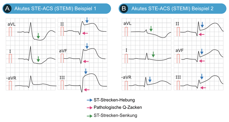 Abbildung 1. Beispiele für STE-ACS (STEMI) Beachten Sie, dass diese Patienten pathologische Q-Zacken aufweisen, was bedeutet, dass diese EKGs mehrere Stunden nach Beginn der Symptome aufgezeichnet wurden oder dass die Q-Zacken Zeichen eines früheren Infarkts sind.