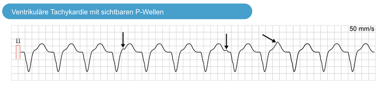 Abbildung 1 (wiederholt). Monomorphe ventrikuläre Tachykardie (VT). P-Wellen sind sichtbar, haben aber keinen Bezug zu den QRS-Komplexen. Diese Situation wird als „AV-Dissoziation“ bezeichnet und weist darauf hin, dass die atriale und ventrikuläre Aktivität unabhängig voneinander stattfindet. Die AV-Dissoziation bestätigt, dass die Arrhythmie eine ventrikuläre Tachykardie ist. Eine AV-Dissoziation ist jedoch häufig schwer zu erkennen.