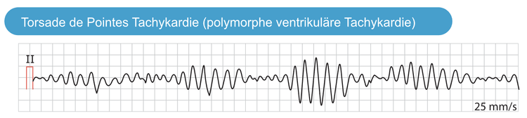 Abbildung 2. Torsade-de-Pointes-Tachykardie (polymorphe ventrikuläre Tachykardie), verursacht durch Long-QT-Syndrom.