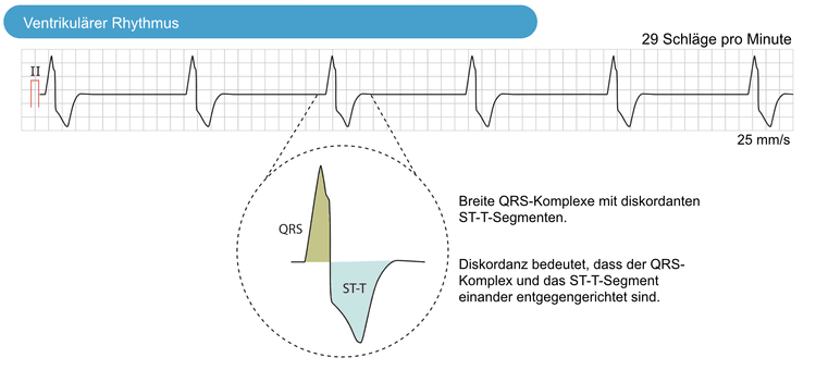 Abbildung 1. Ventrikulärer Rhythmus.