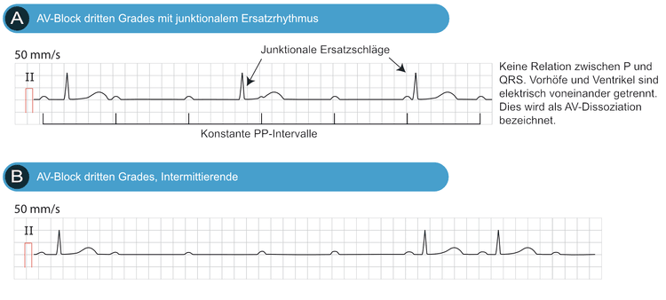 Abbildung 1. AV-Block dritten Grades (vollständiger Herzblock, AV-Dissoziation).