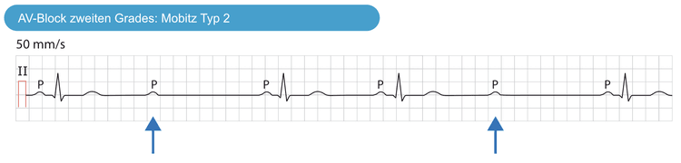 Abbildung 2. AV-Block zweiten Grades Mobitz Typ 2. Einige P-Wellen sind komplett geblockt und es folgen daher keine QRS-Komplexe. Die PR-Intervalle sind konstant und die PP-Intervall regulär.