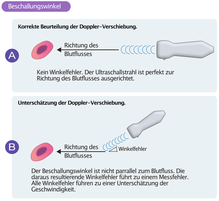 Abbildung 4. Korrekte Beurteilung der Doppler-Verschiebung 
