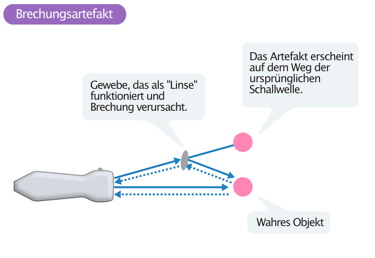 Abbildung 6. Brechungsartefakt.