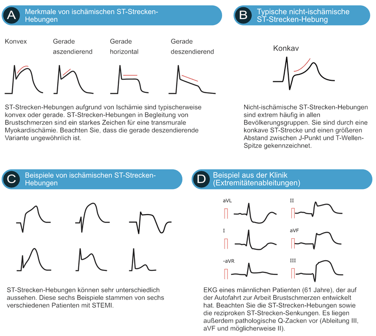 Abbildung 5. Differentialdiagnose von ST-Hebungen.