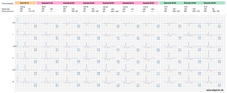 Abbildung 8. Die EKG-Reaktion in den Brustwandableitungen während der Belastung und Erholung.