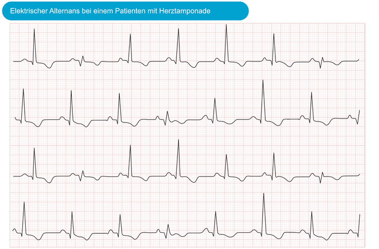 Abbildung 1. Elektrischer Alternans bei Patienten mit Herztamponade. Das EKG zeigt unterschiedliche QRS- und T-Wellen-Amplituden.