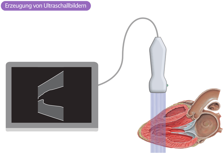 Abbildung 2. Visualisierung von reflektierten Ultraschallwellen: Beim Übergang von einem Gewebe zum anderen werden die meisten Schallwellen reflektiert. Dies verleiht dem Ultraschallbild eine hellere Farbe der Gewebsgrenzen. Das schematische Ultraschallbild zeigt hellere Farben, wenn es von Perikard zu Epikard geht und wenn es vom Endokard zur Ventrikelhöhle geht.