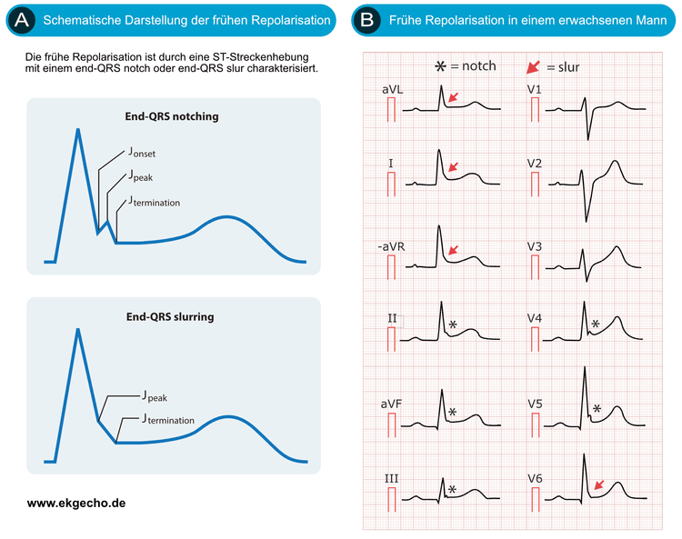 Abbildung 1. Frühes Repolarisationsmuster im EKG. Beachten Sie die Kerben und Verunglimpfungen des End-QRS sowie die Höhe des ST-Strecke.