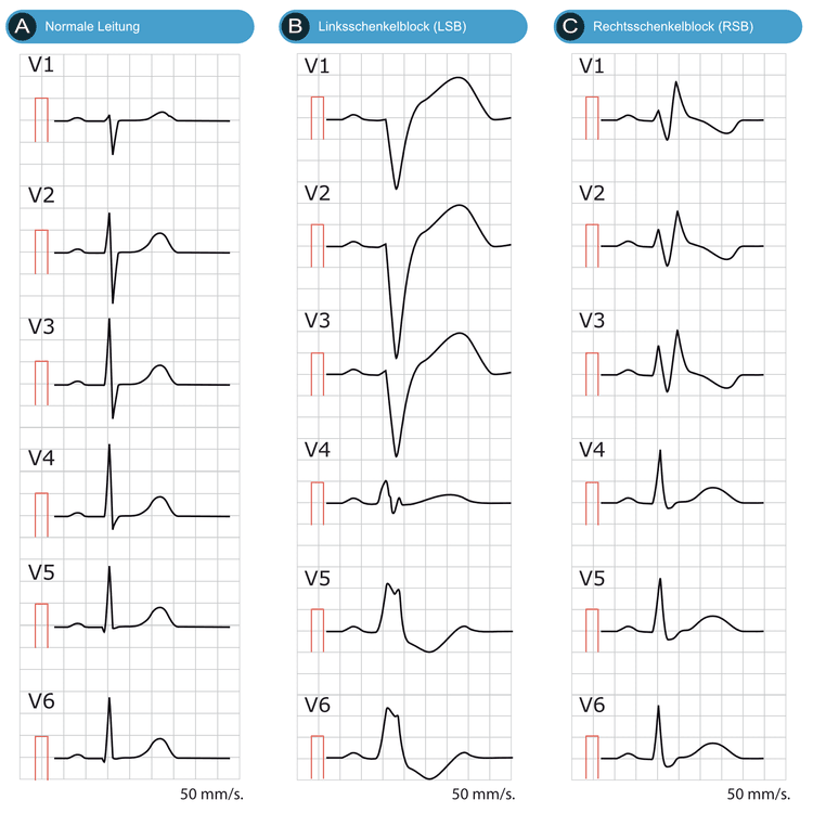 Abbildung 1. Diese EKGs zeigen den Unterschied zwischen normaler Leitung, Linksschenkelblock (LSB) und Rechtsschenkelblock (RSB). Wie aus diesen EKGs hervorgeht, ist der wesentliche Unterschied zwischen normaler Leitung und Schenkelblöcken die QRS-Dauer: Schenkelblöcke werden durch dysfunktionale Tawara-Schenkel verursacht, was zu einer langsamen (und abnormalen) Aktivierung des ventrikulären Myokards und damit zu einer verlängerten QRS-Dauer führt. Eine QRS-Dauer von ≥120 ms (0,12 s) ist erforderlich, um einen Schenkelblock zu diagnostizieren. Beachte auch, dass sowohl der Linksschenkelblock (LSB) als auch der Rechtsschenkelblock (RSB) deutliche ST-T-Veränderungen verursachen, einschließlich ST-Hebungen, ST-Senkungen und invertierten (negativen) T-Wellen. Diese ST-T-Veränderungen sind auf eine abnormale Repolarisation zurückzuführen. Sie sind sowohl beim LSB als auch beim RSB zu erwarten. Wie in der Abbildung zu sehen ist, gibt es deutliche Unterschiede im EKG-Muster zwischen einem LSB und RSB. Diese EKGs werden mit einer Schreibgeschwindigkeit von 50 mm/s gedruckt.