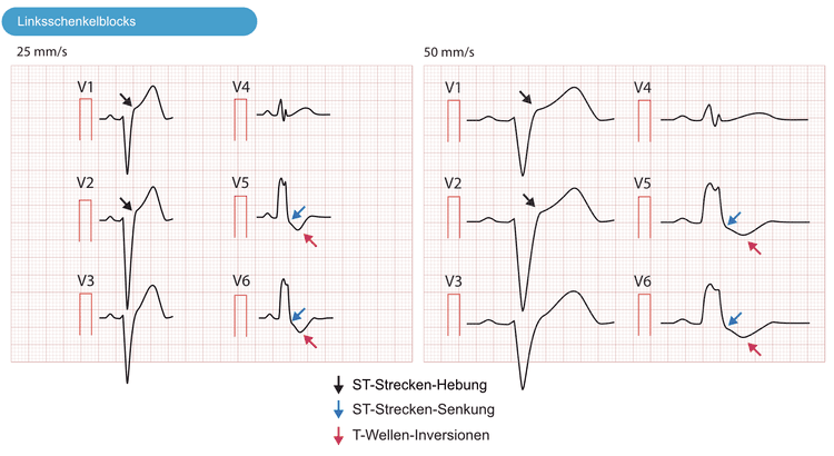 Abbildung 6. Linker Schenkelblock (LBBB) bei zwei verschiedenen Papiergeschwindigkeiten mit ST-Hebungen und ST-Senkungen.